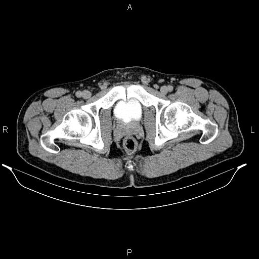 Adrenal myelolipoma (Radiopaedia 87794-104246 Axial renal excretory phase 103).jpg