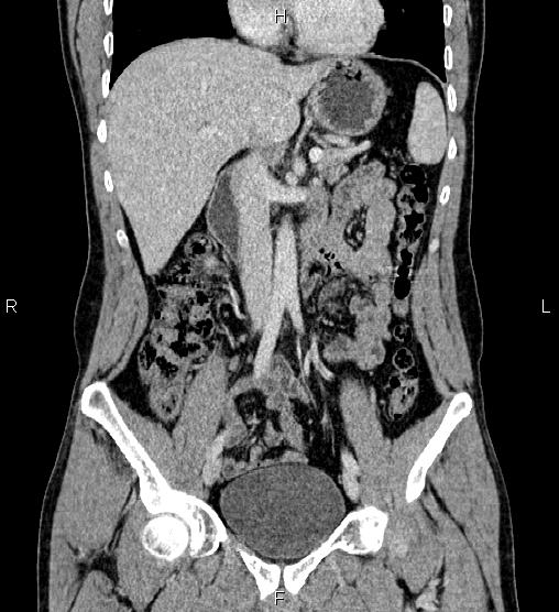 Adrenal myelolipoma (Radiopaedia 87794-104246 Coronal renal cortical phase 28).jpg