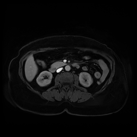 Adrenal myelolipoma - MRI (Radiopaedia 83249-97646 T1 fat sat arterial phase 52).jpg