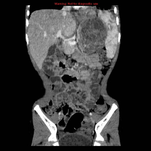 File:Adrenocortical carcinoma (Radiopaedia 9449-10131 Coronal C+ portal venous phase 4).jpg