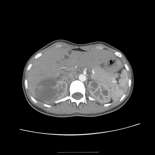 File:Adult polycystic kidney disease (Radiopaedia 48845-53876 Axial renal cortical phase 12).jpg
