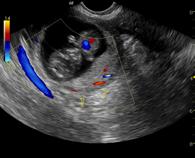 File:Advanced ectopic pregnancy (Radiopaedia 12862-12983 Transverse 1).jpg