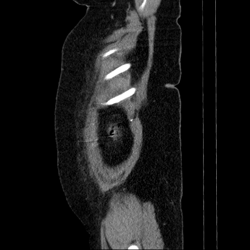 Afferent loop syndrome - secondary to incarcerated trocar site hernia (Radiopaedia 82959-97305 Sagittal C+ portal venous phase 144).jpg