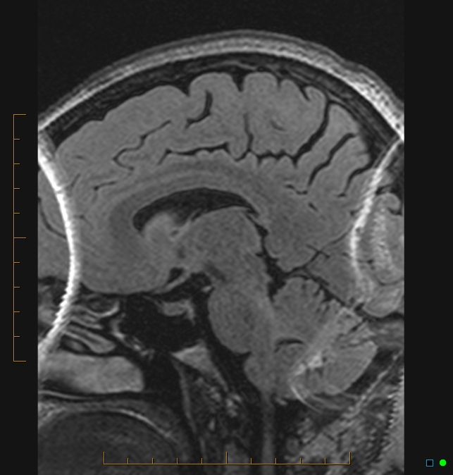 Aliasing artifact causing a spurious cerebellar lesion (Radiopaedia 48783-53810 Sagittal FLAIR 56).jpg