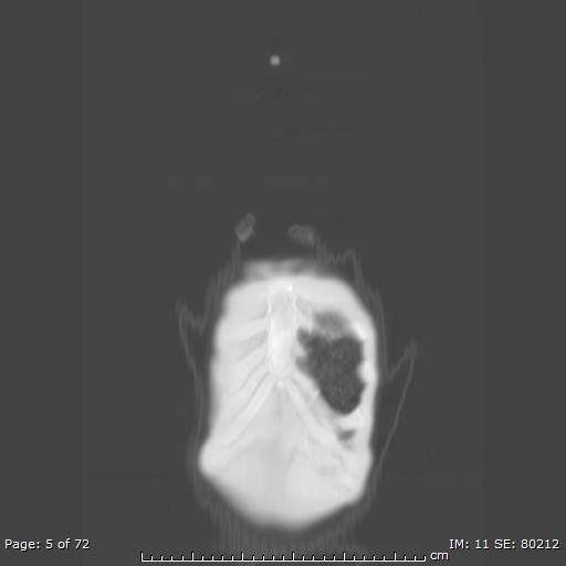 Alpha-1-antitrypsin deficiency (Radiopaedia 50561-55987 Coronal lung window 3).jpg