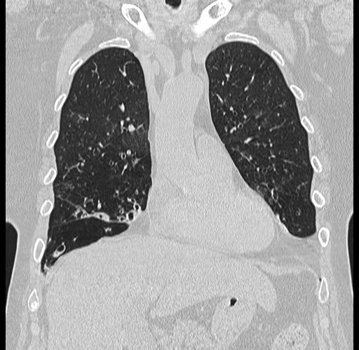 Alpha-1-antitrypsin deficiency (Radiopaedia 72058-82557 Coronal lung window 19).jpg