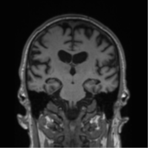 Alzheimer's disease- with Gerstmann syndrome and dressing apraxia (Radiopaedia 54882-61150 Coronal T1 42).png