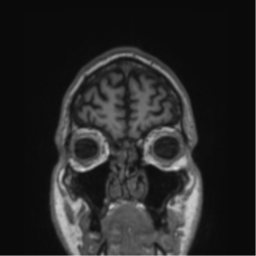 Alzheimer's disease- with Gerstmann syndrome and dressing apraxia (Radiopaedia 54882-61150 Coronal T1 81).png