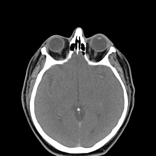 Ameloblastoma (Radiopaedia 38520-40623 Axial non-contrast 1).png