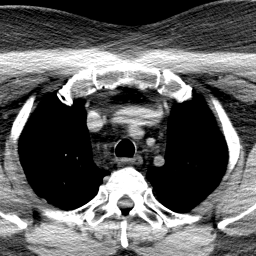 Ameloblastoma (Radiopaedia 38520-40623 Axial non-contrast 83).png