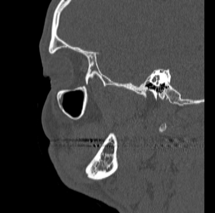 Ameloblastoma (Radiopaedia 77750-89997 Sagittal bone window 74).jpg
