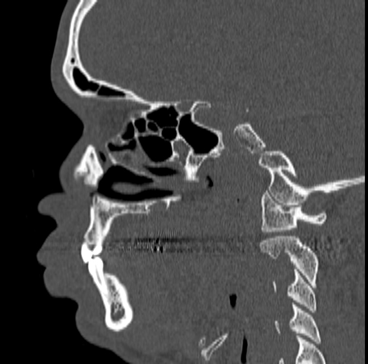 Ameloblastoma (Radiopaedia 77750-89997 Sagittal bone window 9).jpg