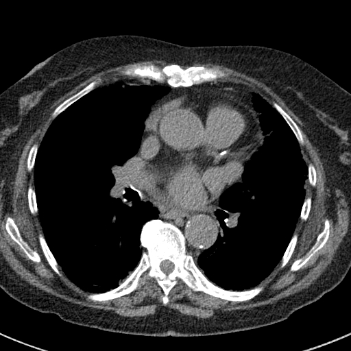 File:Amiodarone-induced pulmonary fibrosis (Radiopaedia 82355-96460 Axial non-contrast 33).jpg