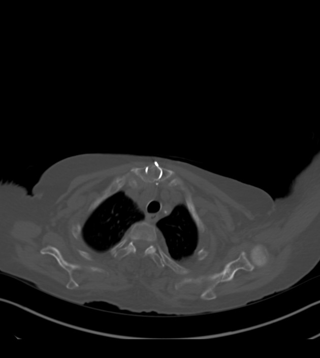 Amiodarone deposition in the liver (Radiopaedia 77587-89780 Axial bone window 13).jpg