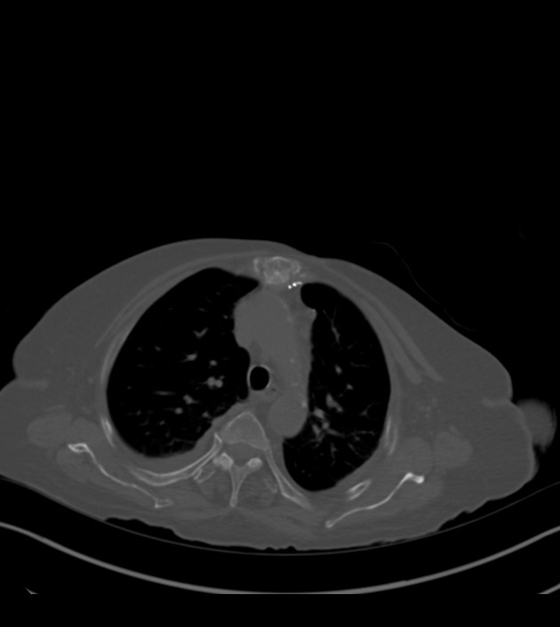 Amiodarone deposition in the liver (Radiopaedia 77587-89780 Axial bone window 25).jpg