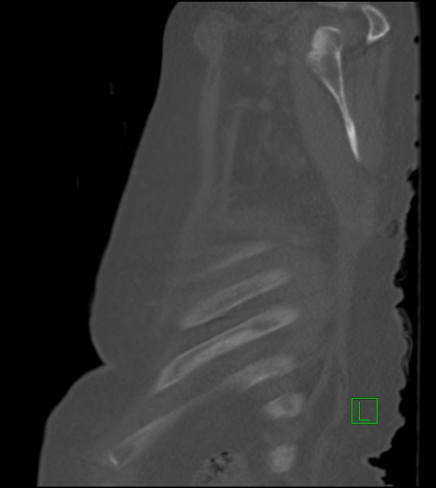Amiodarone deposition in the liver (Radiopaedia 77587-89780 Sagittal bone window 15).jpg
