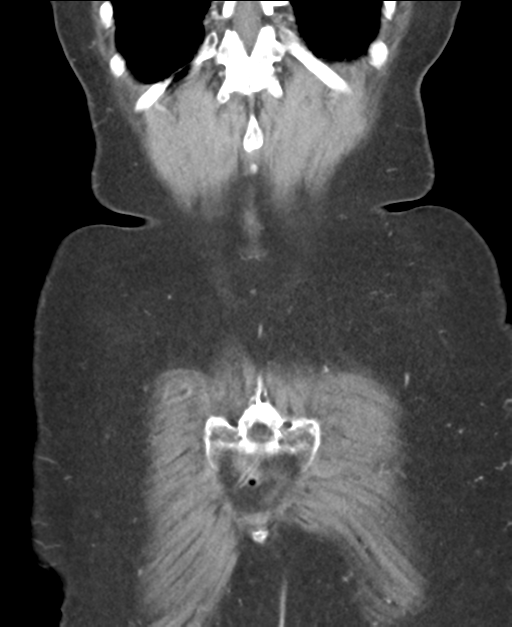 Ampullary adenocarcinoma (Radiopaedia 34013-35237 E 46).png