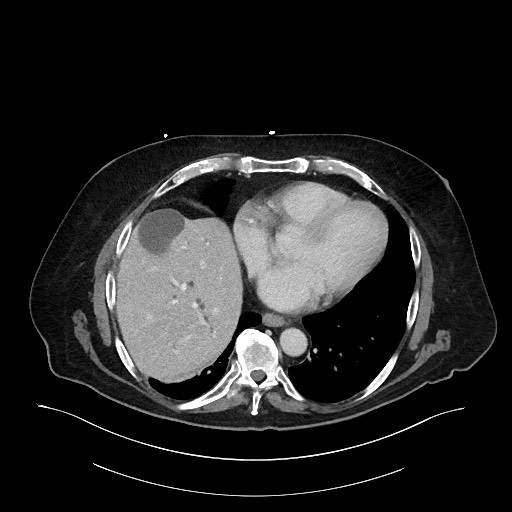 Ampullary adenocarcinoma (Radiopaedia 59373-66734 C 20).jpg