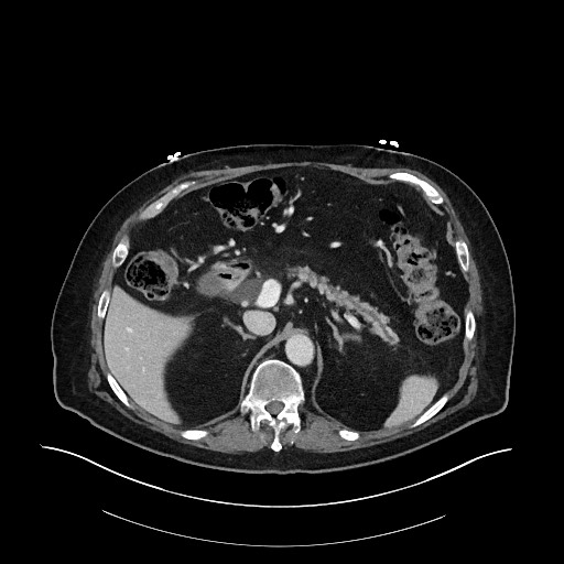 File:Ampullary adenocarcinoma (Radiopaedia 59373-66734 C 49).jpg