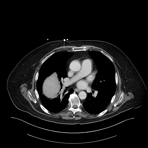 Ampullary adenocarcinoma (Radiopaedia 59373-66734 C 6).jpg