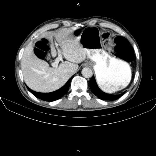 Ampullary adenocarcinoma (Radiopaedia 86093-102032 A 13).jpg