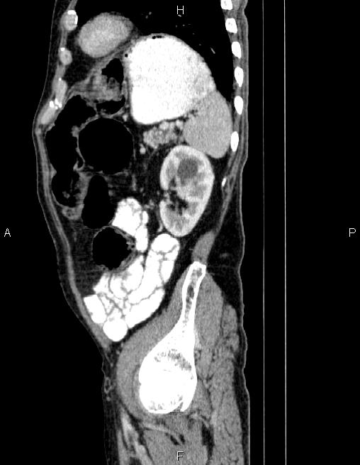 Ampullary adenocarcinoma (Radiopaedia 86093-102032 D 76).jpg