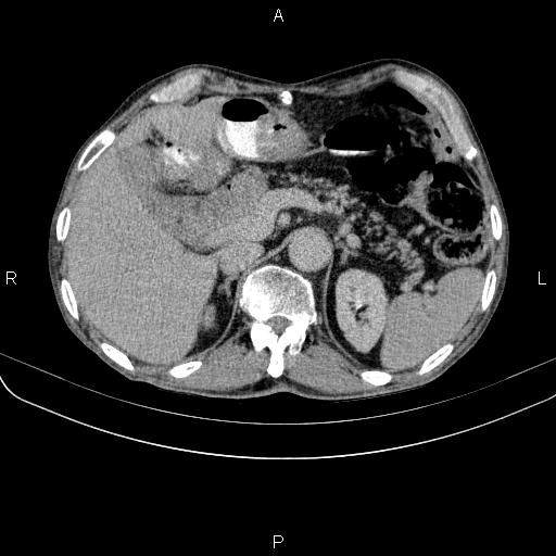 Ampullary adenocarcinoma (Radiopaedia 86093-102033 Axial C+ delayed 32).jpg