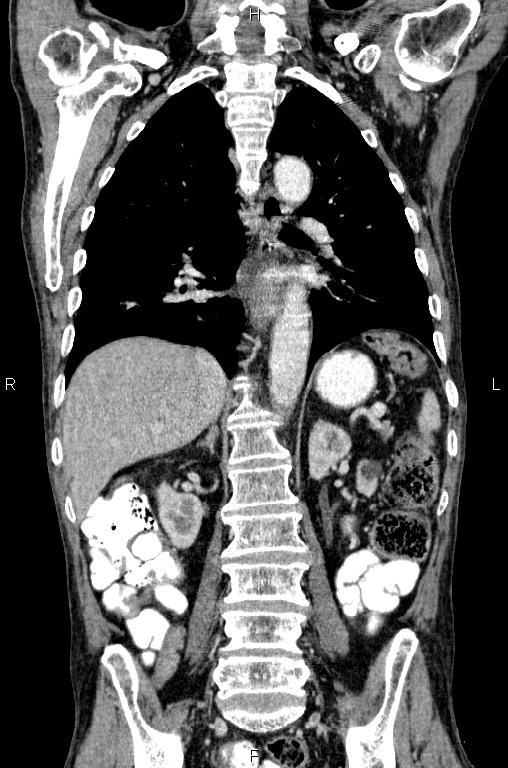 Ampullary adenocarcinoma (Radiopaedia 86093-102033 D 38).jpg
