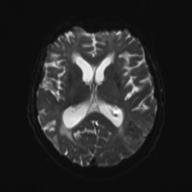 File:Amyloid angiopathy with inflammation (Radiopaedia 30360-31002 Axial B0 and DWI 18).jpg