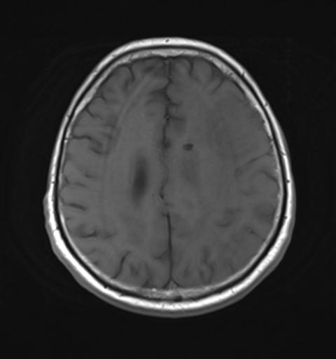 File:Amyloid angiopathy with inflammation (Radiopaedia 30360-31002 Axial T1 23).jpg