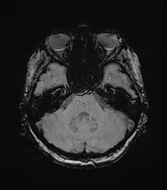 Anaplastic astrocytoma (Radiopaedia 86943-103160 Axial SWI 27).png