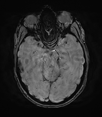 File:Anaplastic astrocytoma IDH mutant (Radiopaedia 50046-55341 Axial SWI 34).png