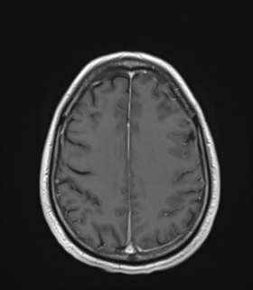 Anaplastic astrocytoma IDH wild-type (Radiopaedia 49984-55273 Axial T1 C+ 42).png