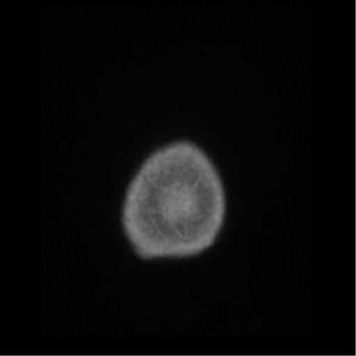 Anaplastic astrocytoma IDH wild-type (pseudoprogression) (Radiopaedia 42209-45276 Axial T1 C+ 151).png