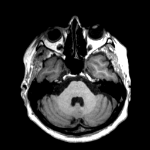 Anaplastic astrocytoma IDH wild-type (pseudoprogression) (Radiopaedia 42209-45277 Axial T1 35).png