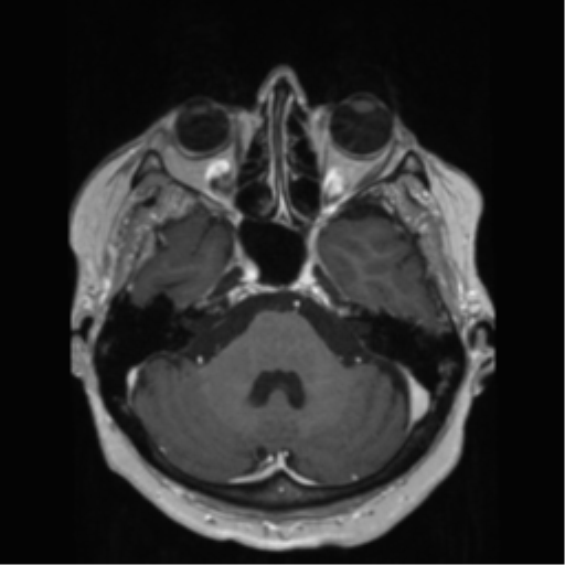 File:Anaplastic astrocytoma IDH wild-type (pseudoprogression) (Radiopaedia 42209-45278 Axial T1 C+ 50).png