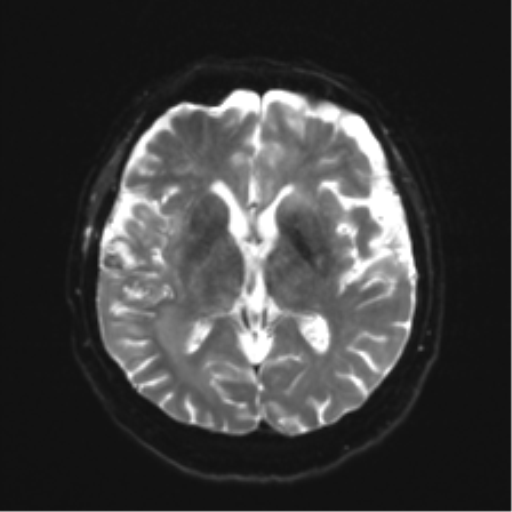 Anaplastic astrocytoma IDH wild-type (pseudoprogression) (Radiopaedia 42209-45279 Axial DWI 14).png