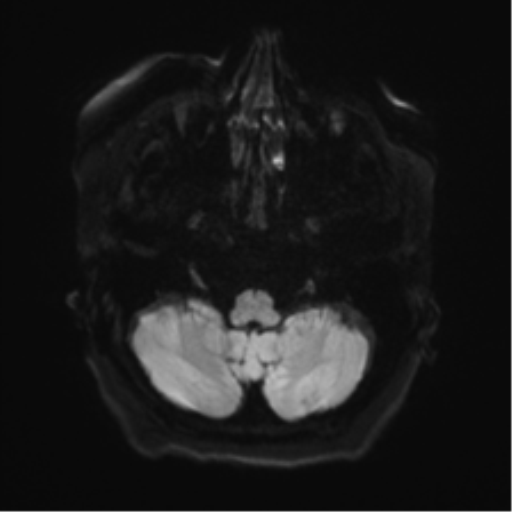 Anaplastic astrocytoma IDH wild-type (pseudoprogression) (Radiopaedia 42209-45279 Axial DWI 32).png