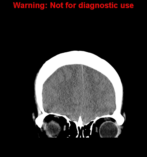 File:Anaplastic ganglioglioma (Radiopaedia 44921-48815 Coronal non-contrast 8).jpg