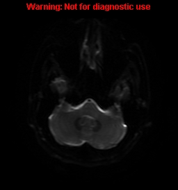 File:Anaplastic ganglioglioma (Radiopaedia 44921-48831 Axial DWI 37).jpg
