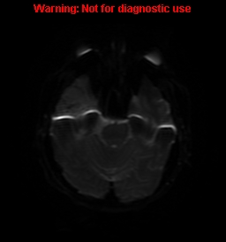 File:Anaplastic ganglioglioma (Radiopaedia 44921-48831 Axial DWI 40).jpg