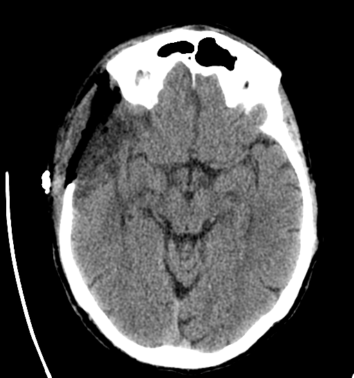 File:Anaplastic meningioma with recurrence (Radiopaedia 34452-35786 Axial non-contrast 14).png