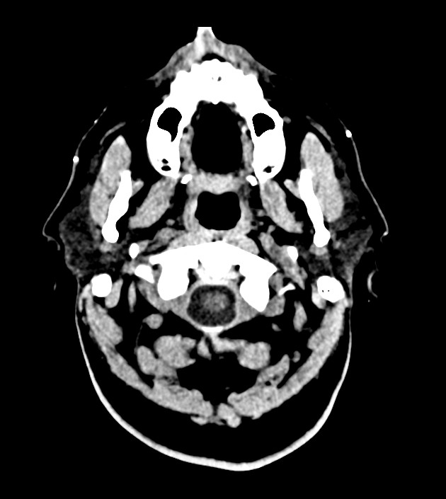 Anaplastic oligodendroglioma (Radiopaedia 79571-92758 Axial non-contrast 1).jpg