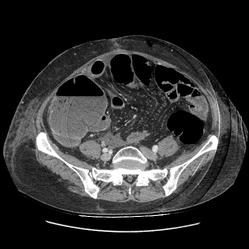 Anastomosis leak at ileostomy closure site (Radiopaedia 82138-96184 B 157).jpg
