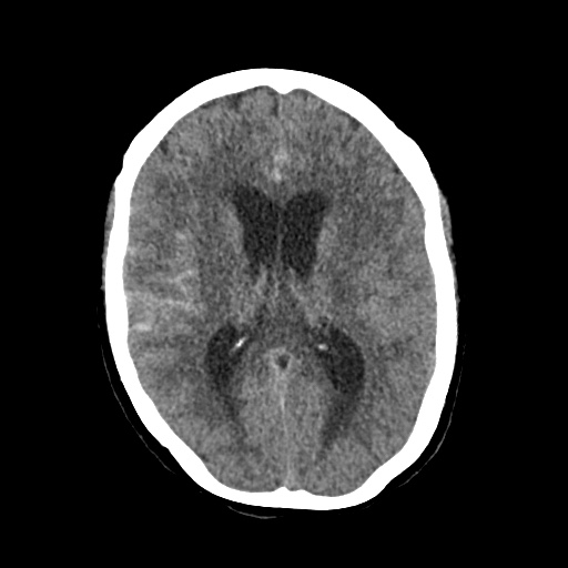 File:Aneursym related subarachnoid hemorrhage with hydrocephalus (Radiopaedia 45105-49083 Axial non-contrast 27).jpg