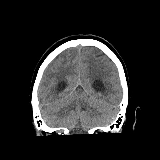 Aneursym related subarachnoid hemorrhage with hydrocephalus (Radiopaedia 45105-49083 Coronal non-contrast 49).jpg
