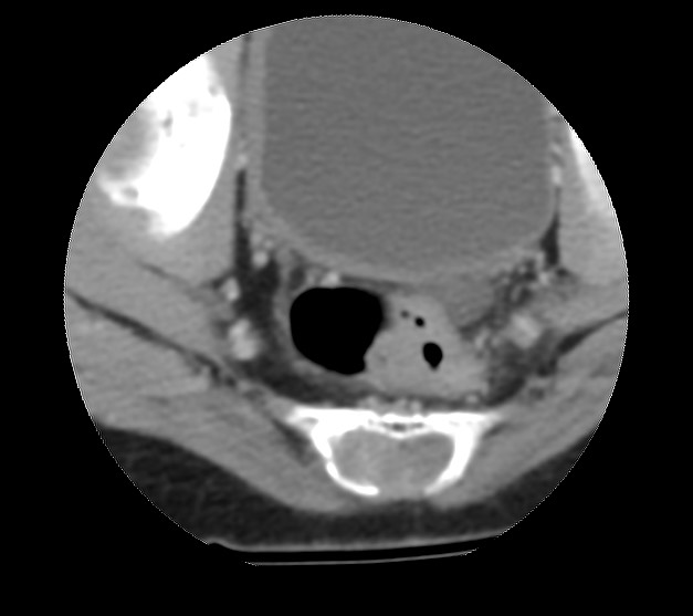 Aneurysmal bone cyst - sacrum (Radiopaedia 65190-74195 Axial non-contrast 39).jpg