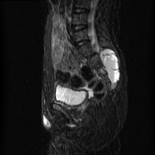 File:Aneurysmal bone cyst - sacrum (Radiopaedia 65190-74196 Sagittal STIR 19).jpg