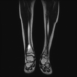 File:Aneurysmal bone cyst - tibia (Radiopaedia 22343-22367 Coronal T2 7).jpg