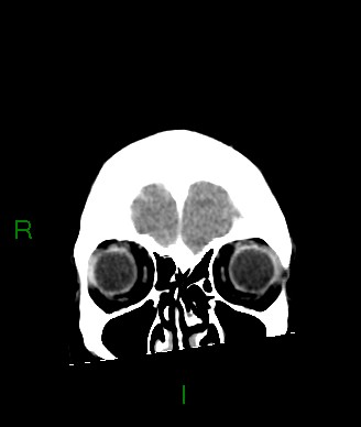 Aneurysmal subarachnoid hemorrhage with intra-axial extension (Radiopaedia 84371-99699 Coronal non-contrast 58).jpg